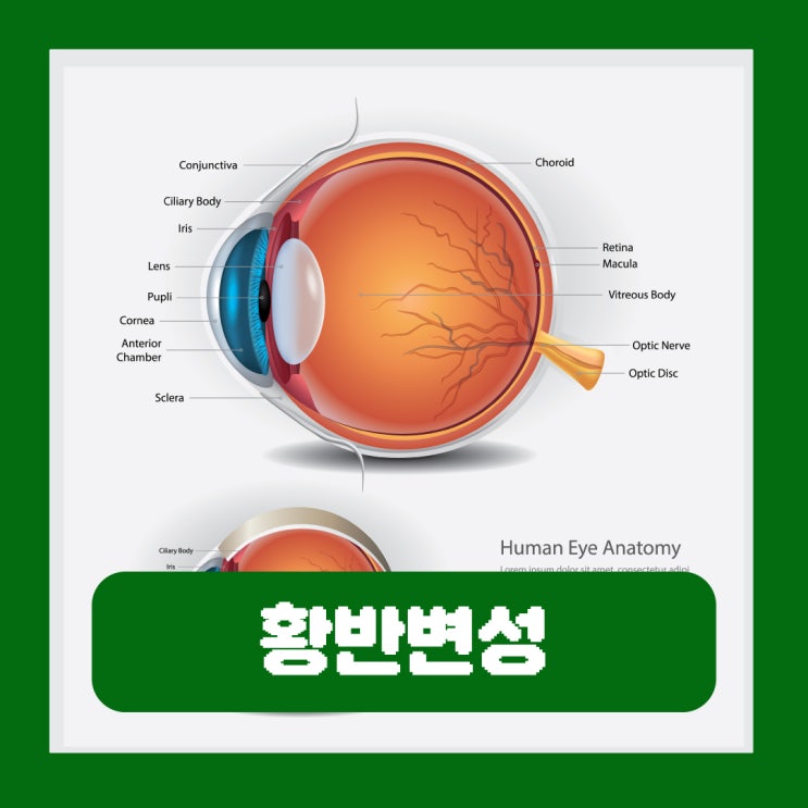  황반변성 증상 원인 치매 전조증상 테스트 영양제로 좋은 성분