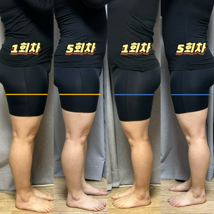  수원비만클리닉, 안빠지던 허벅지살! 하프컷 지방분해주사 사진비교