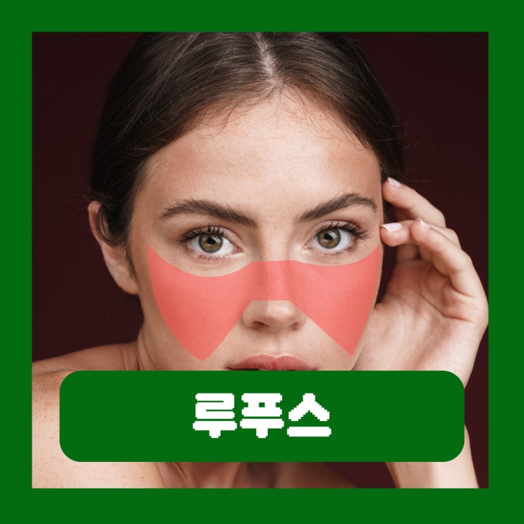  홍반 루푸스 얼굴 피부 증상 루푸스병 검사 치료 완치 임신