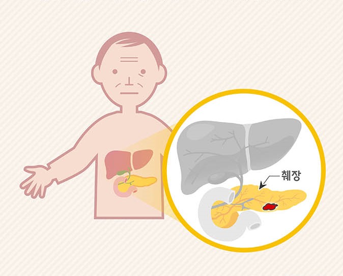  한국인에게 흔한 암 '췌장암' 인포그래픽 (2024)