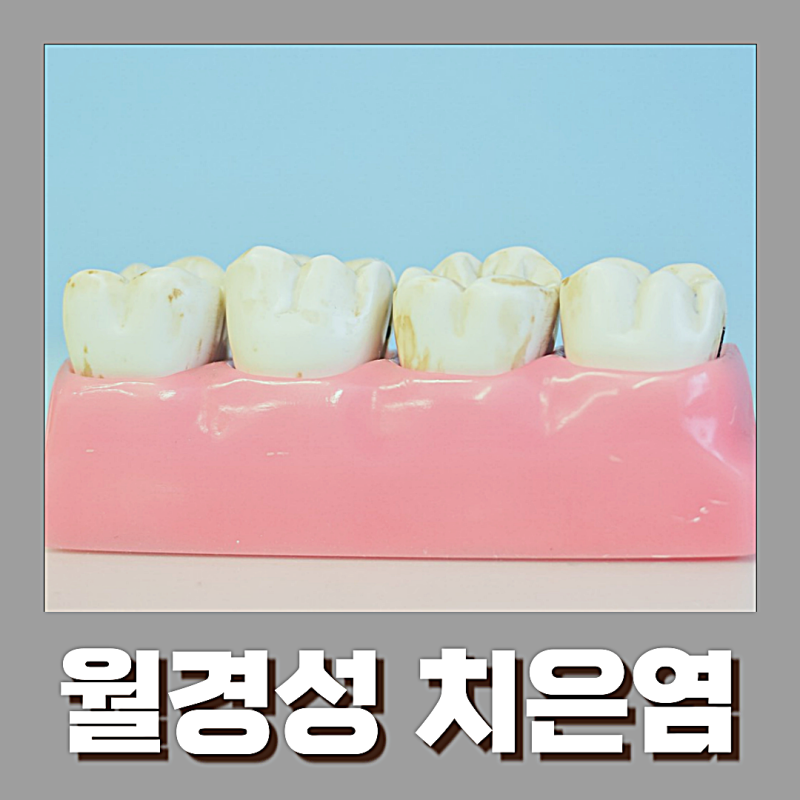 월경성 치은염의 증상과 치료법