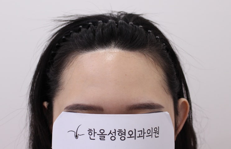 20대 여성 헤어라인 비절개 마이크로컷 2500모 2주 경과