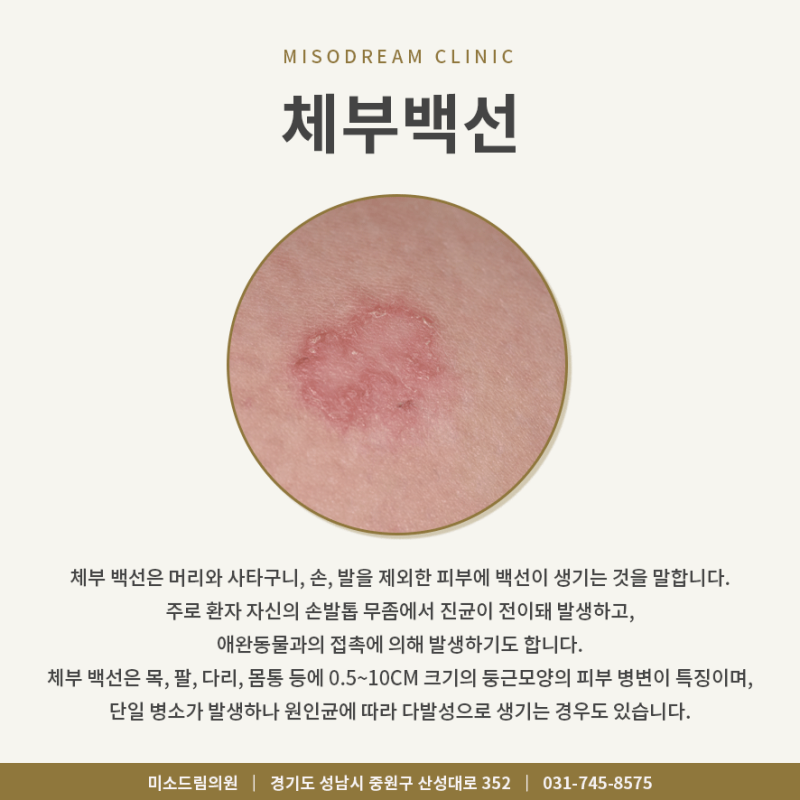 체부 백선 두피