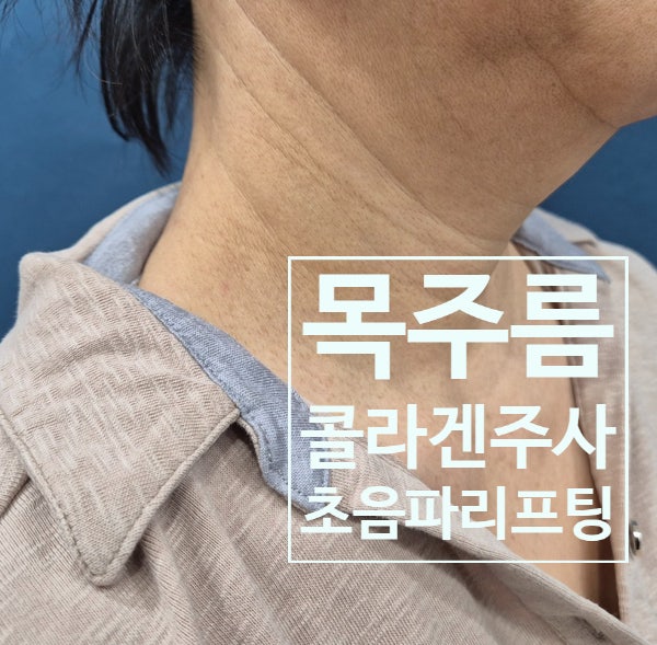  레디어스와 초음파리프팅으로 가로목주름 시술효과