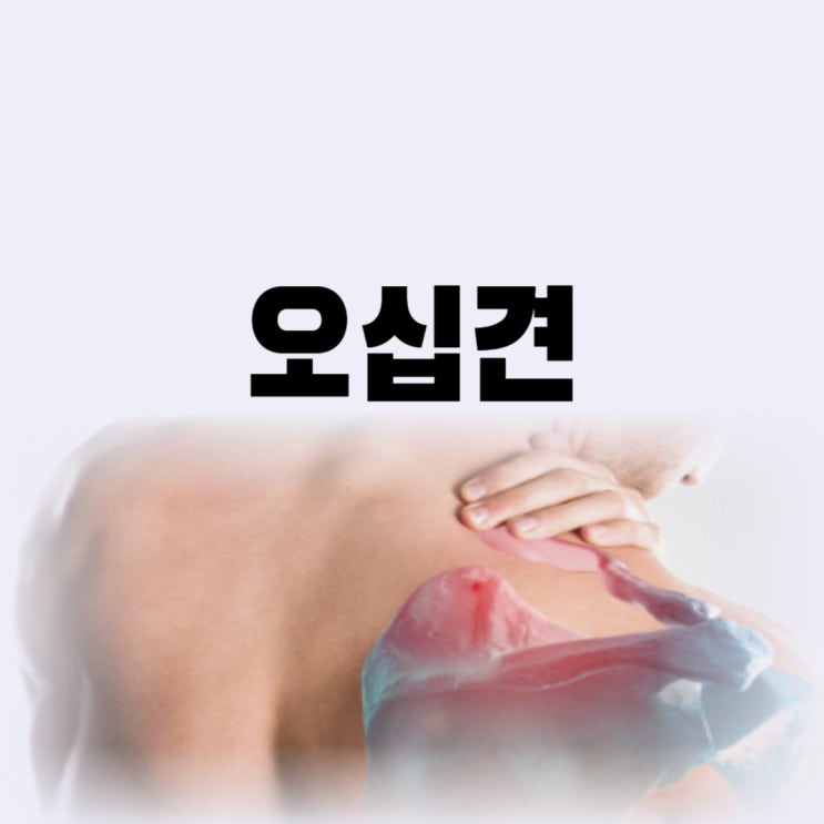  오십견초기증상 치료방법 어깨 운동 예방 가능할까