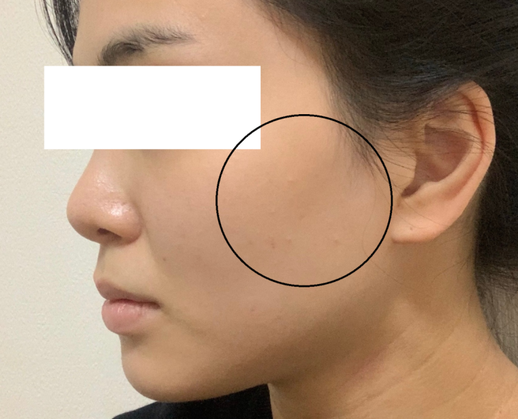  알고 보면 별거 없는 턱보톡스 부작용, 볼 패임, 원리, 이유. 안 패이게 시술 받는 법.