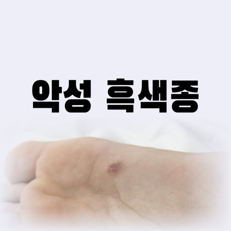  흑색종 초기증상 손톱 발톱 피부에 점 생겼을 때 제거 가능할까