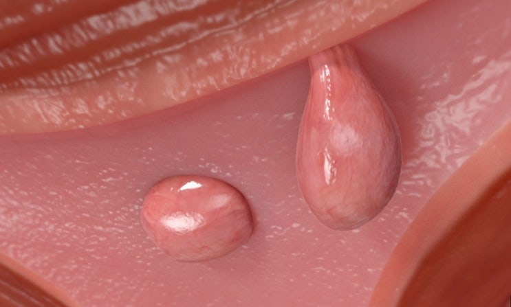  자궁내막 용종 원인과 임신, 폐경 전후 치료