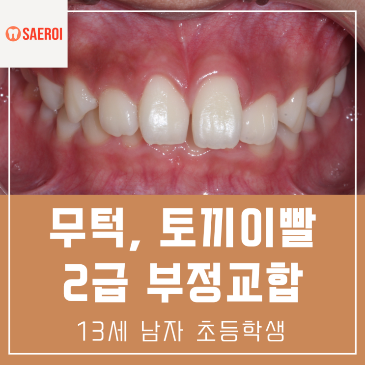  아래턱이 작은 무턱, 토끼 이빨 2급 부정교합 / 13세 남자 초등학생