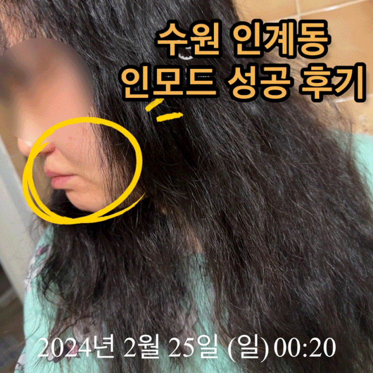  수원 인모드 후기 인계동 피부과 추천! (feat. 내돈내산)