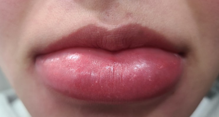 필러 녹이는 주사, 히알라제/히알루로니다제 (Hyaluronidase) 시술 부작용, 알러지/알레르기 반응, 대처, 해결법. 붓기, 간지러움, 빨개짐.