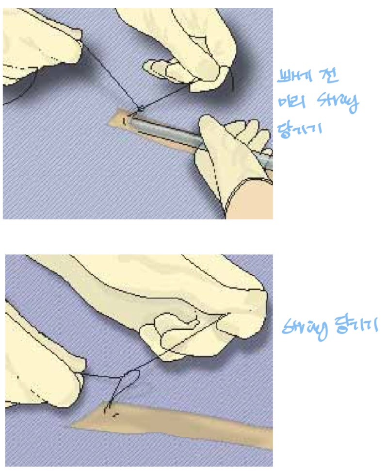 인턴일기 9월 : 흉부외과 인턴주치의 + 흉관chest tube제거 + 기흉pneumothorax : 네이버 블로그
