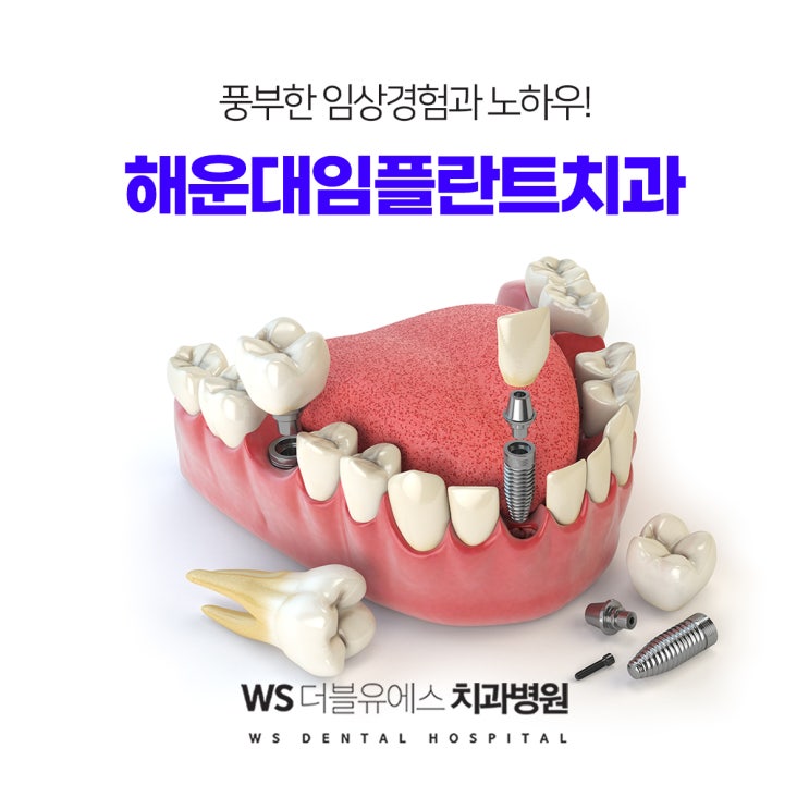  양산임플란트잘하는곳 찾으시나요