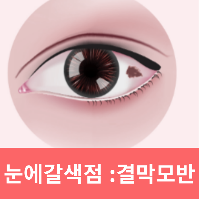  눈에갈색점 결막 모반제거 후기 (1년 만에 재발)