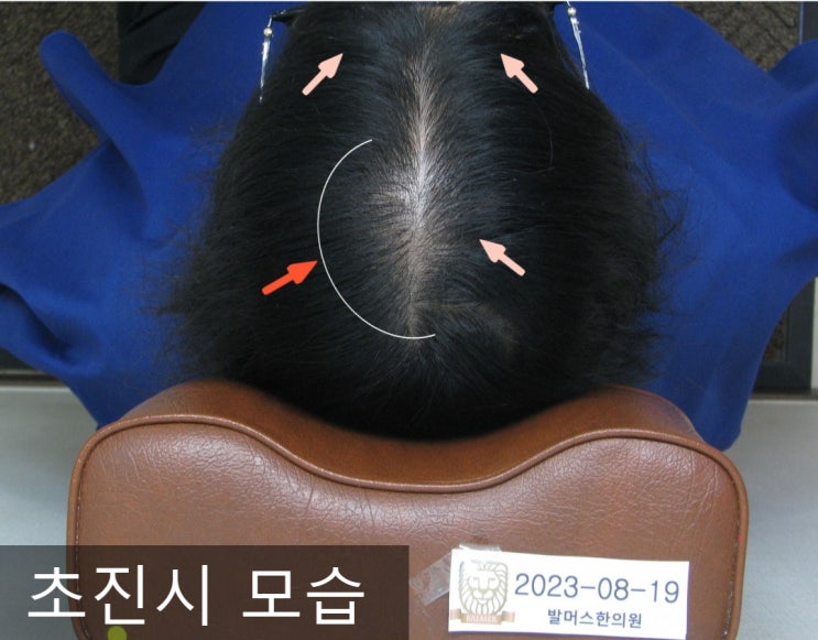  마포탈모, 여자 가르마 탈모 치료하고 머리숱 회복한 사례