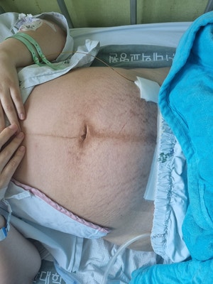  [출산/arter_1] 단일양막/일란성쌍둥이/고위험산모/대학병원출산/퇴원/내 몸인 듯 내 몸 아닌 내 몸 같은 나...?