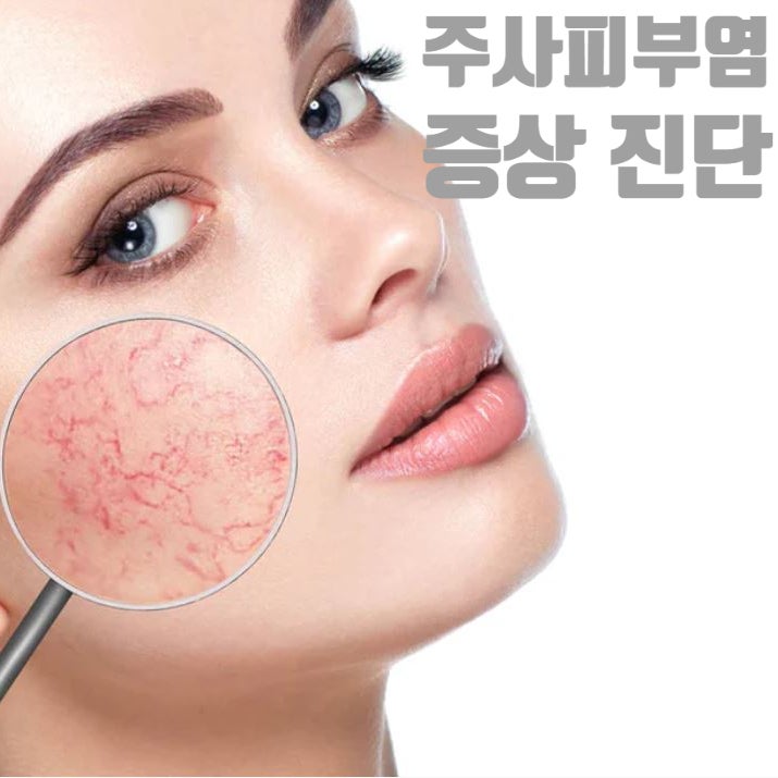  주사(Rosacea)피부염의 진단과 임상양상
