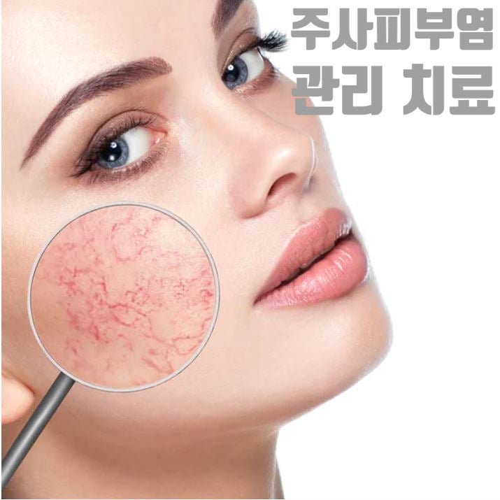  주사(Rosacea)피부염의 치료 (먹는약/바르는약/레이저/스킨보톡스)