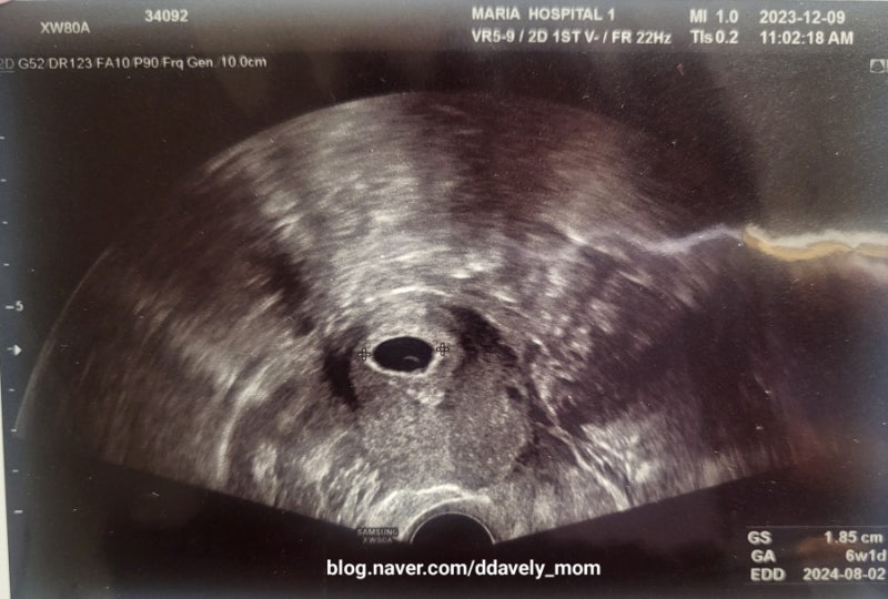 [임신스토리] 임신 6-8주차 태아 초음파, 태아 심장소리, 주수별 태아 크기, 6-8주차 임신 증상 : 네이버 블로그