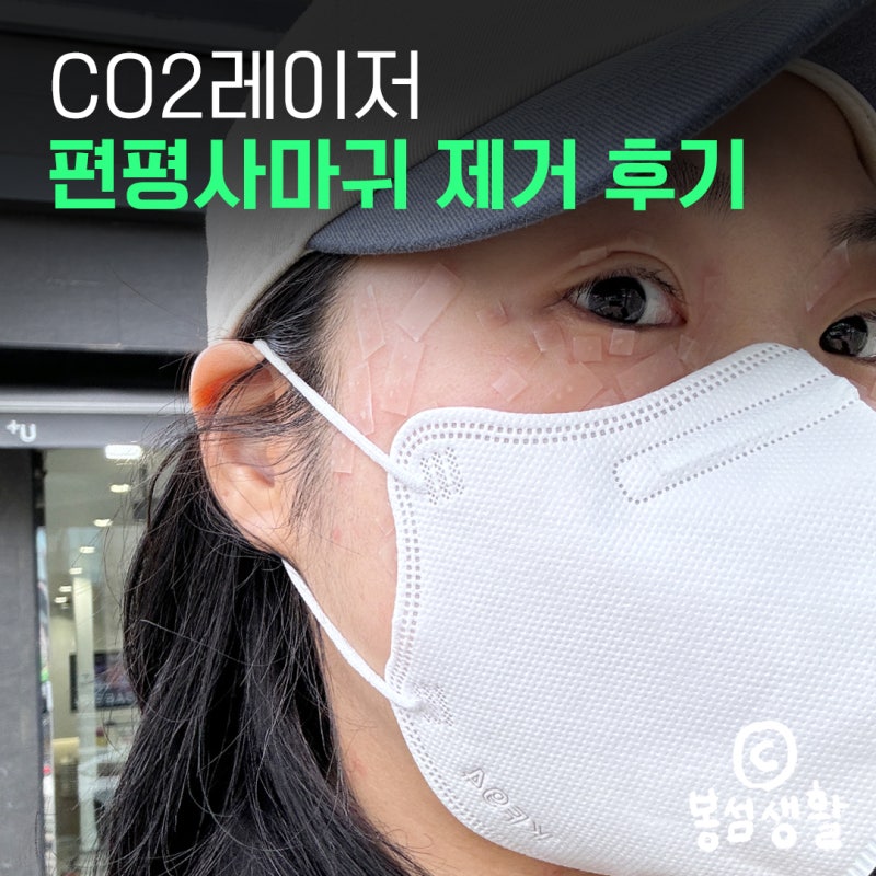비립종, 점, 체리점, 쥐젖, 편평사마귀 제거 내돈내산 후기 | CO2 레이저 | 통증 및 가격 | 시....