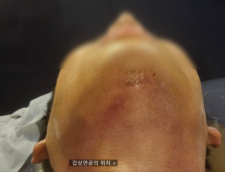  얼굴 근육묶기 바본이 생긴다면 '이곳'은 꼭 풀어주어야 합니다.