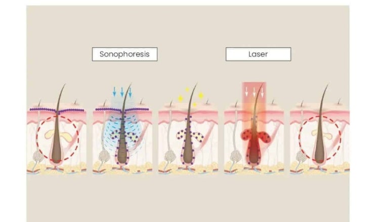  여드름/피지 예방 시술, 골드PTT (Photothermal therapy) 효과, 후기, 원리, 여드름 없애는 법, 피지 줄이는 법. 제거