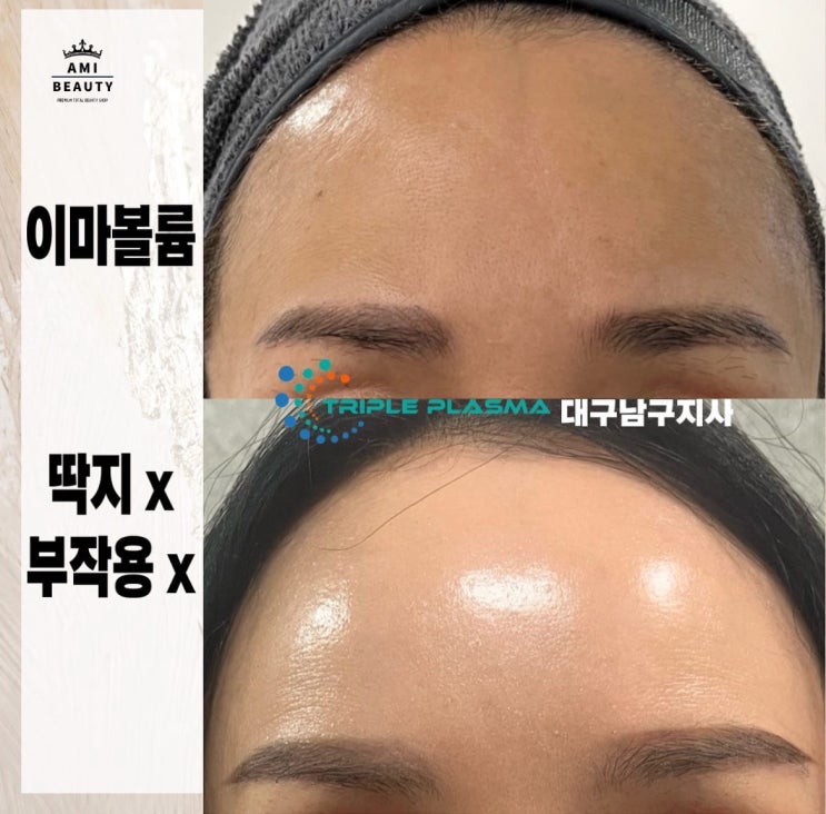  대구플라즈마 전문 이마볼륨 빵빵!필러x 자연성형 거상흉터 개선!부작용 없이 예뻐지는 방법!아미뷰티