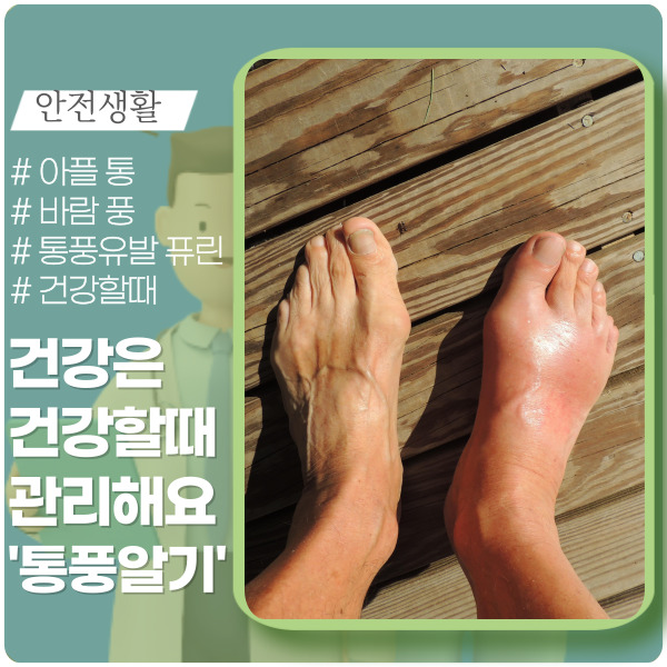 통풍 증세와 원인, 예방법은?