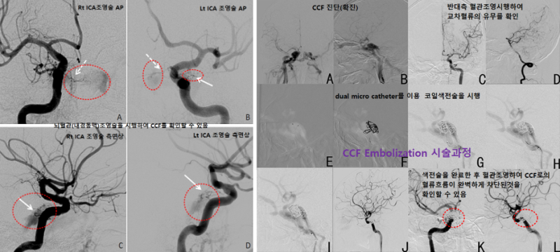 목동맥 해면정맥굴샛길 색전술 (Carotid Cavernous Fistula, CCF Embolization) : 네이버 블로그