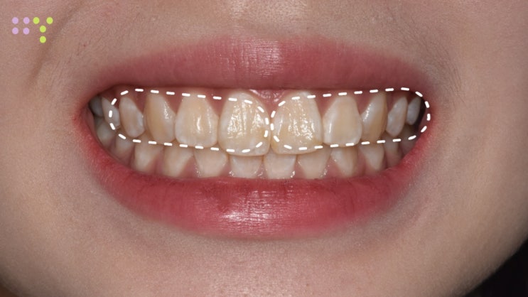 반점치 앞니 하얀점 치아 손상없는 안전한 치료 방법은?