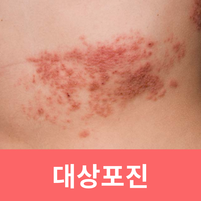  수포없는 대상포진증상 원인 전염성