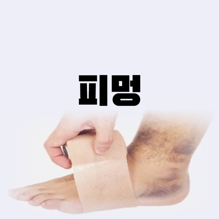  멍이 잘드는 이유 피멍 빨리 빼는법 3가지