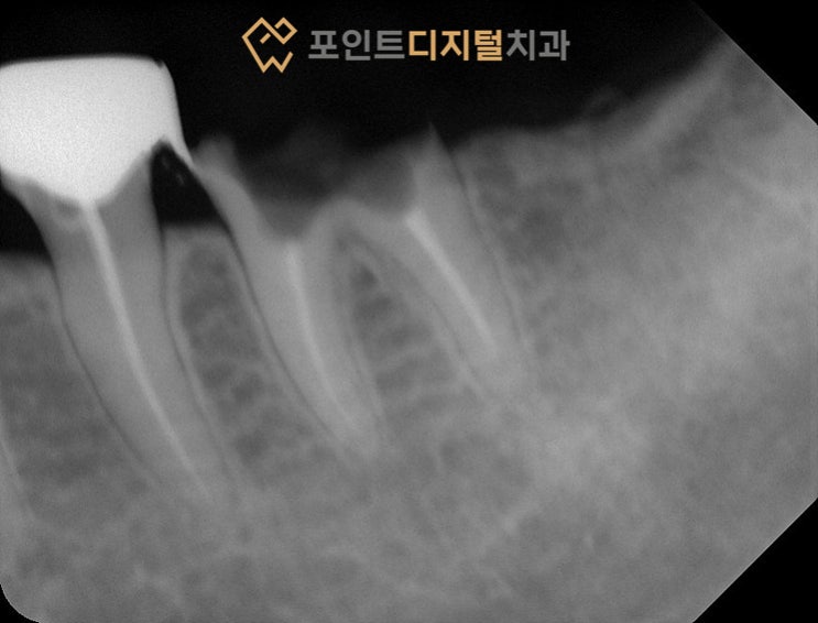  [탕정치과] 임플란트 14년 경과(발치즉시 임플란트, 덴티움) / 천안 아산