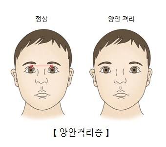  리섭증후군(Hypertelorism)이란? 리섭증후군에 대한 모든