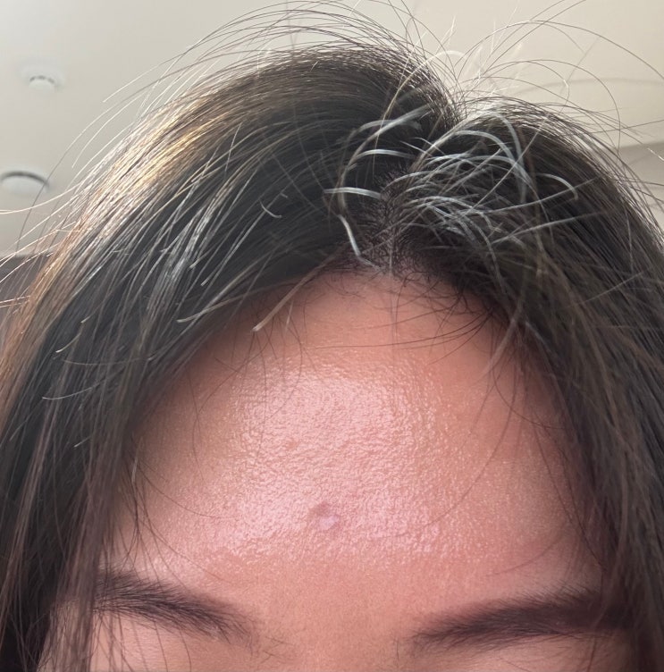 홍대 수두자국제거 새살침 치료 후기(2) 홍대 수두자국제거 새살침 치료 후기(2)