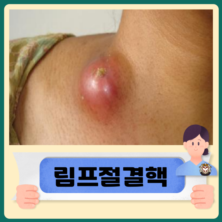  림프절 결핵 진단 및 치료방법