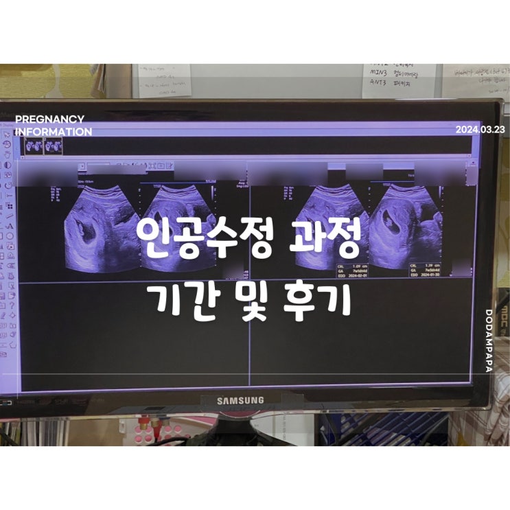 인공수정 과정 기간 후기 인공수정 과정 기간 후기
