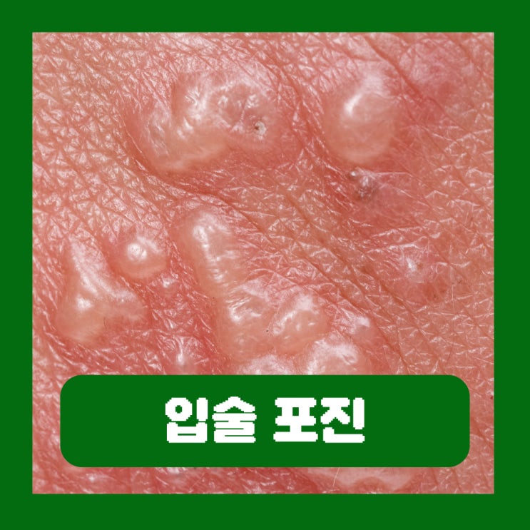  입술 포진 빨리 치료 기간 딱지 원인 입술주변포진 술