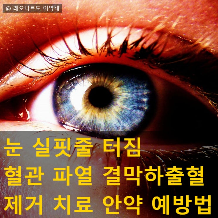 결막하출혈 예방법 눈 실핏줄 터짐 치료 안약 눈실핏줄터짐 혈관 파열 제거