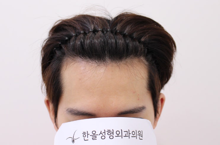  20대 남성 미용목적 헤어라인 교정 비절개 2500모