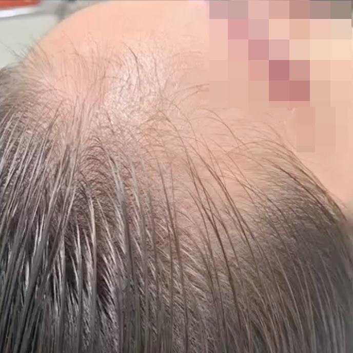  분당에서 유명한 여성 두피 문신 헤어라인 타투, 동안 얼굴의 비결