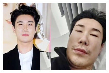  래퍼 산이 부비동염으로 얼굴 퉁퉁 부어, 증상 치료 예방법