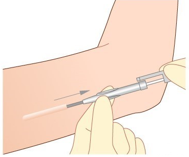  임플라논 시술 후 장점과 부작용, 팔 고주파 치료 및 지방 흡입