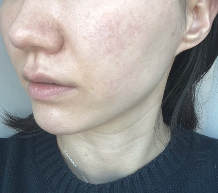  홍조레이저 엑셀브이레이저후기 + 뉴아꼴레이드 같이받기