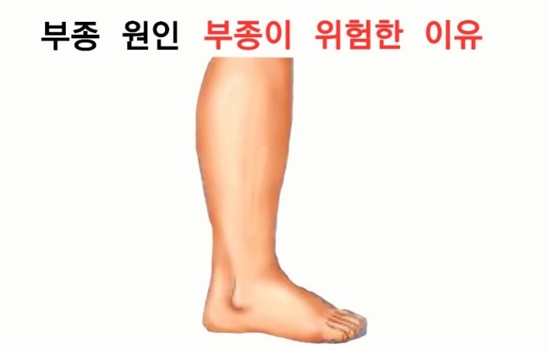 부종 원인 부종이 위험한 이유 : 네이버 블로그