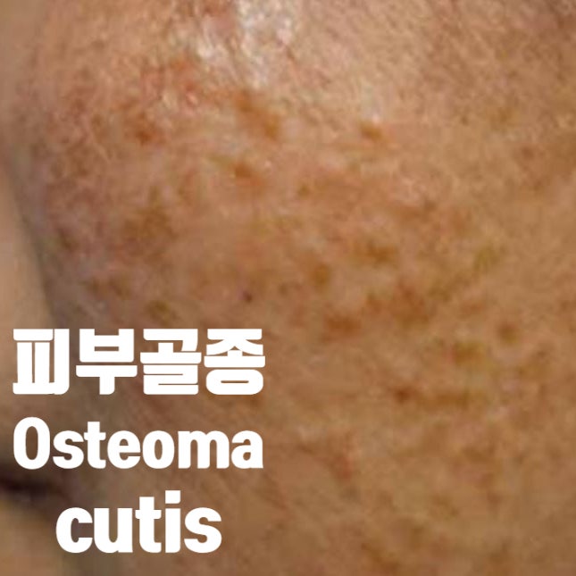  피부 안에 뼈조직이 있다고? 피부골종(Osteoma cutis)