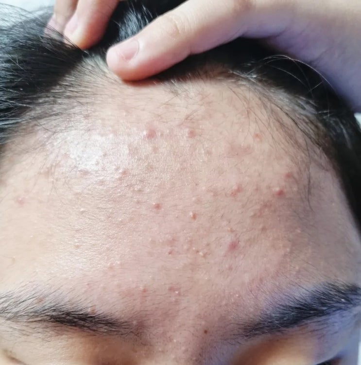  청소년 좁쌀 여드름비누 피부에  진정되는 항균 허브마사지바