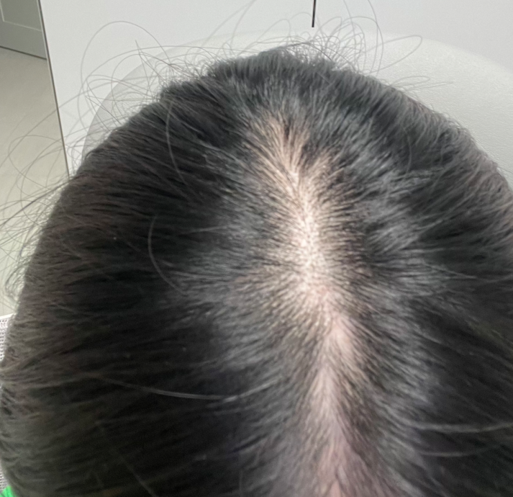  모발이식 망하고 탈모 두피문신 3회차 변화 후기