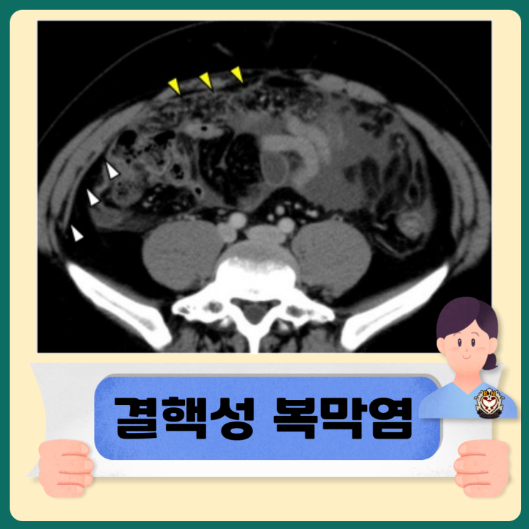  복부결핵 결핵성 복막염 치료방법