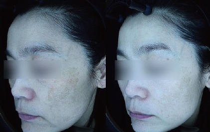 해운대 기미치료 실패하는 이유? -피부과 전문의 작성 해운대 기미치료 실패하는 이유? -피부과 전문의 작성
